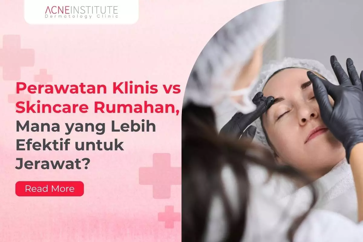 Perawatan Klinis vs Skincare Rumahan, Mana yang Lebih Efektif untuk Jerawat?