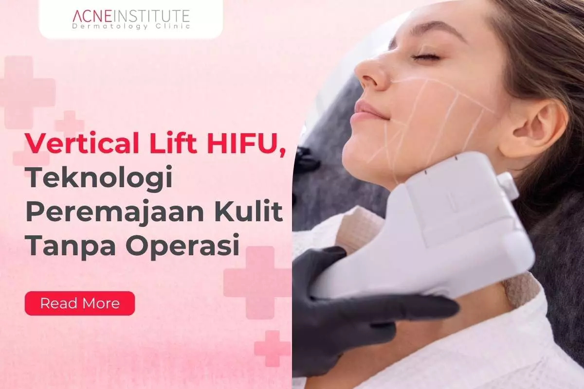 Vertical Lift HIFU, Teknologi Peremajaan Kulit Tanpa Operasi
