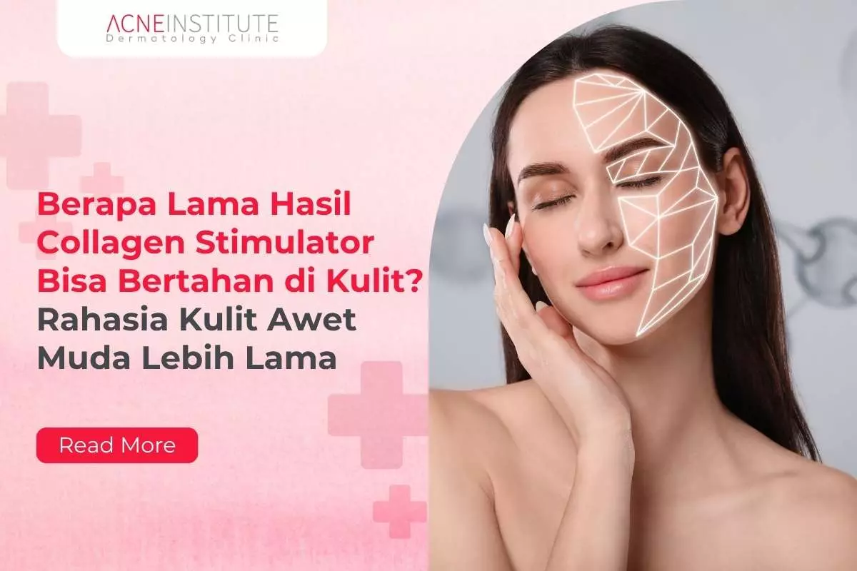 Berapa Lama Hasil Collagen Stimulator Bisa Bertahan di Kulit? Rahasia Kulit Awet Muda Lebih Lama