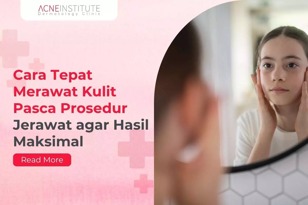 Cara Tepat Merawat Kulit Pasca Prosedur Jerawat agar Hasil Maksimal