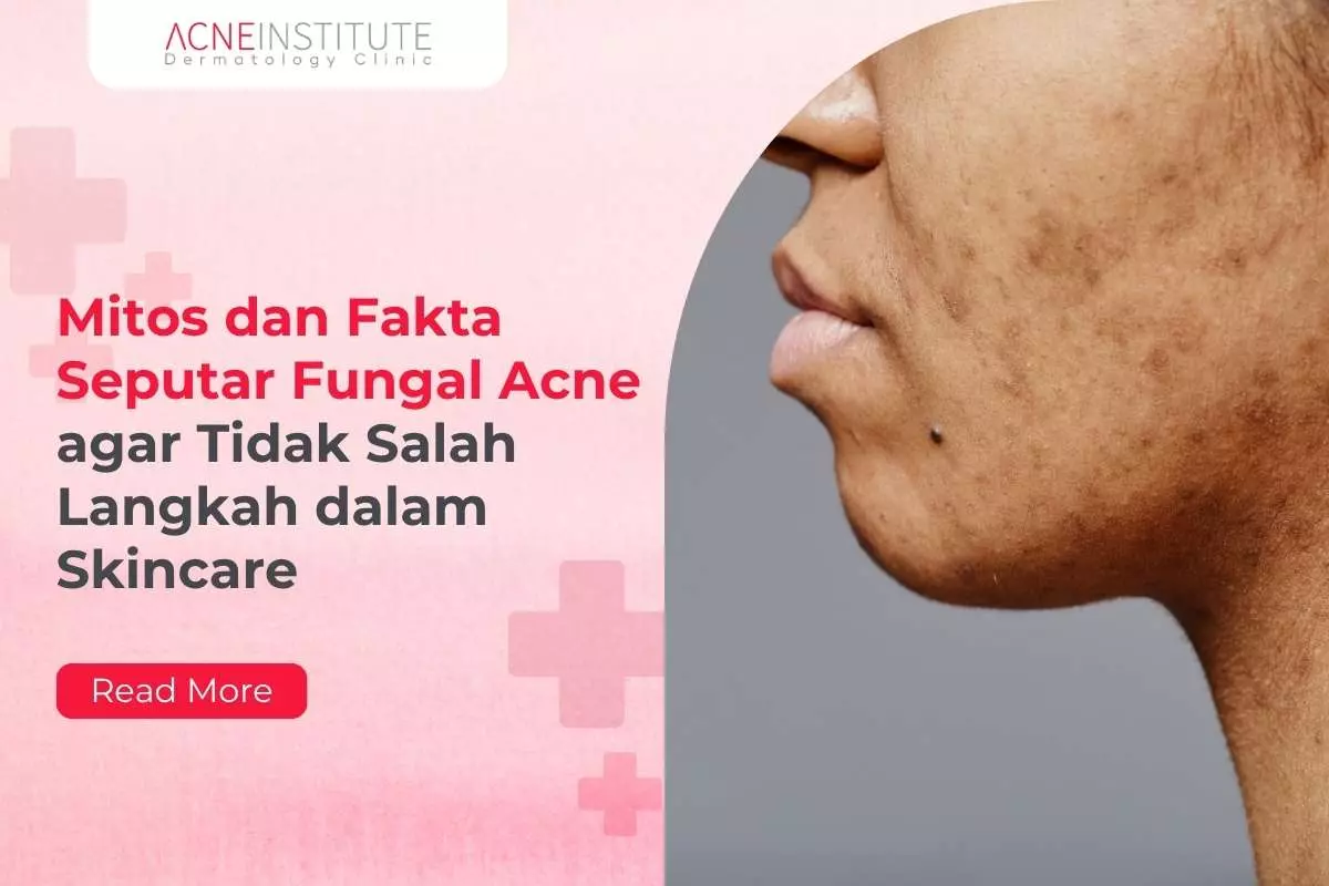 Mitos dan Fakta Seputar Fungal Acne agar Tidak Salah Langkah dalam Skincare