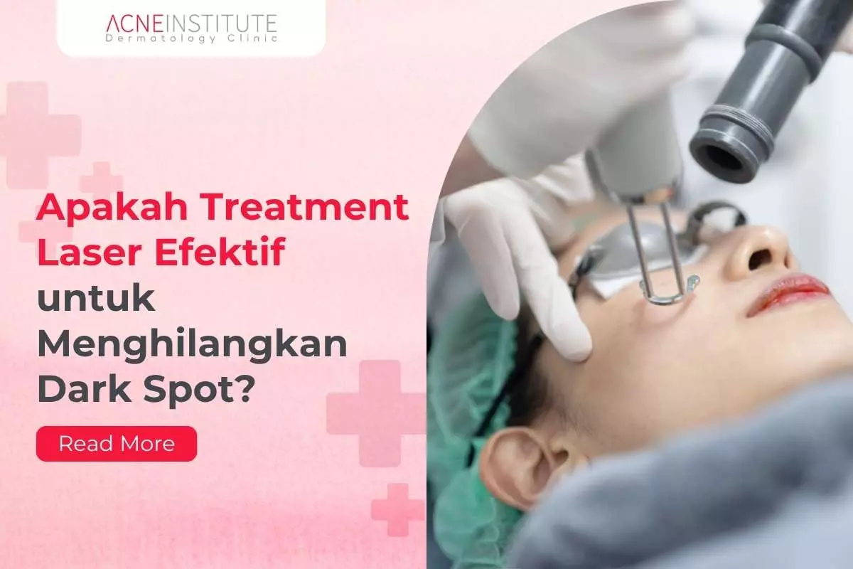 Apakah Treatment Laser Efektif untuk Menghilangkan Dark Spot?