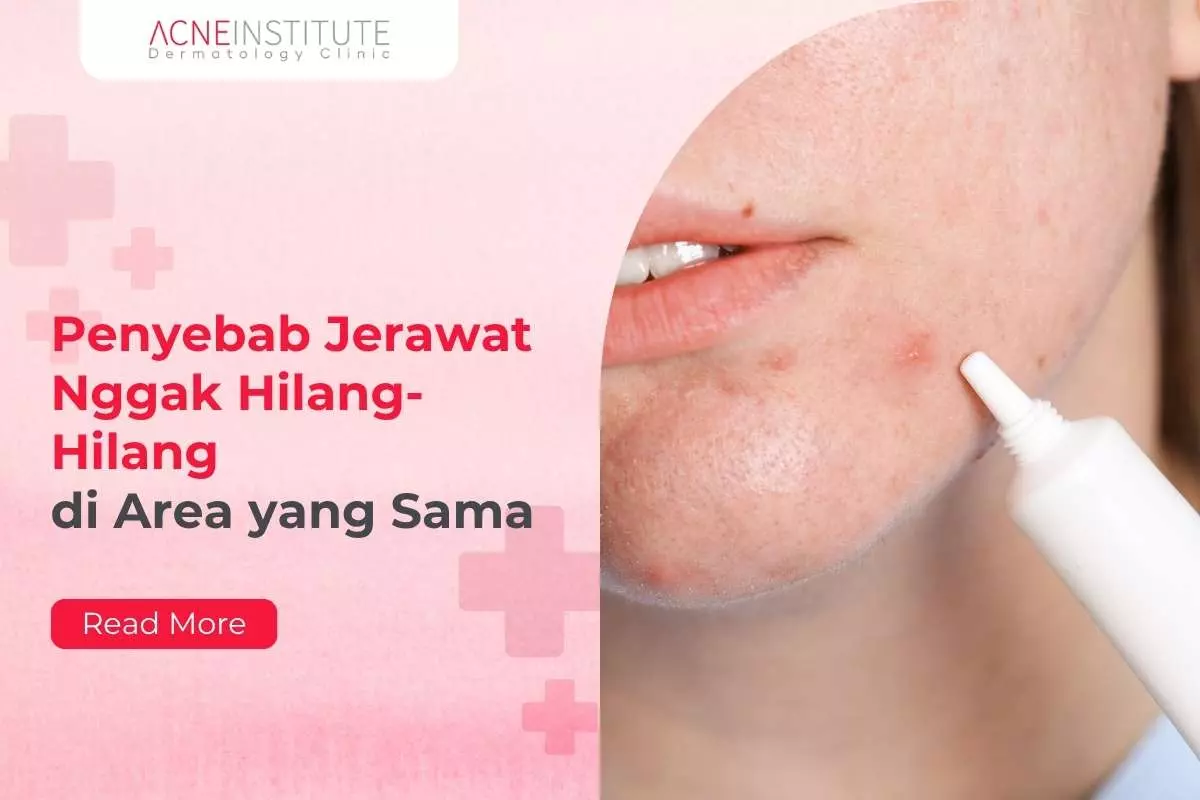 Penyebab Jerawat Nggak Hilang-Hilang di Area yang Sama