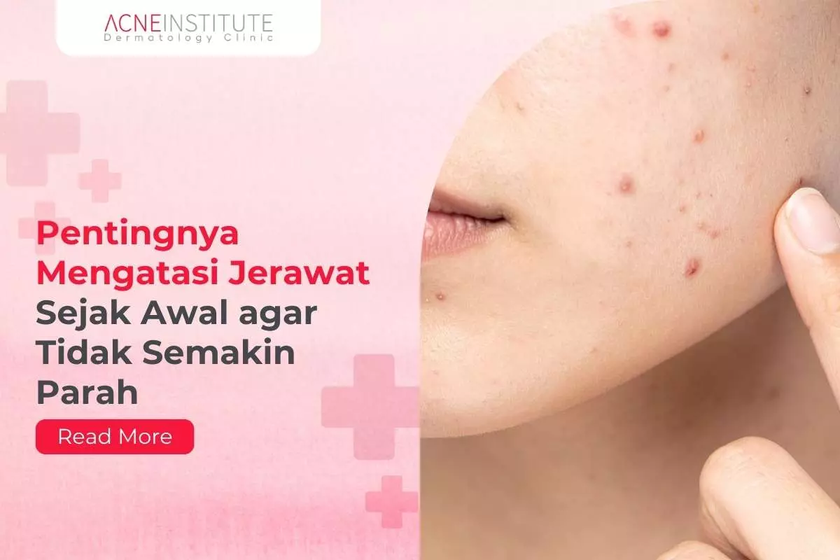 Pentingnya Mengatasi Jerawat Sejak Awal agar Tidak Semakin Parah