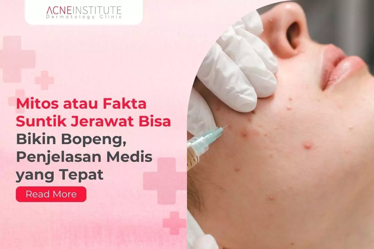 Mitos atau Fakta Suntik Jerawat Bisa Bikin Bopeng, Penjelasan Medis yang Tepat