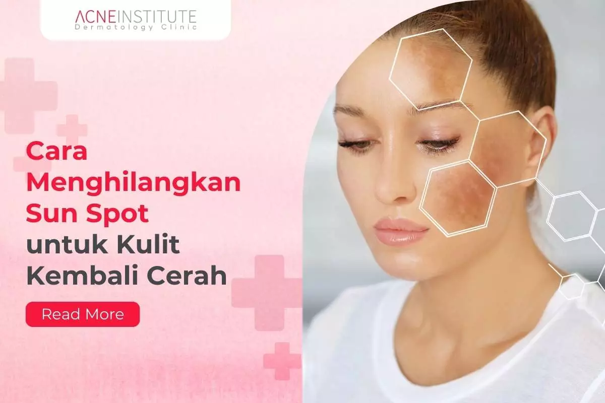 Cara Menghilangkan Sun Spot untuk Kulit Kembali Cerah