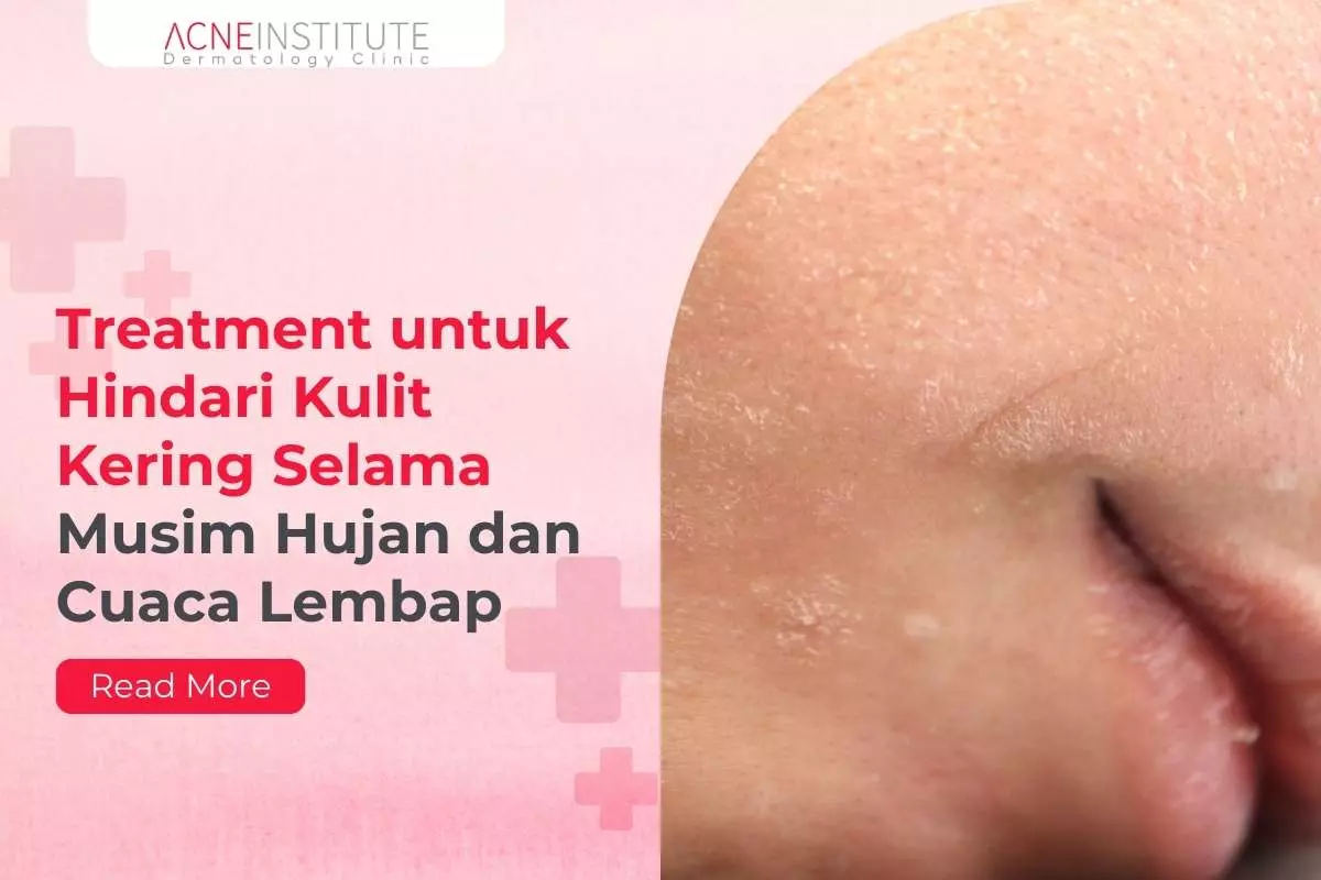 Treatment untuk Hindari Kulit Kering Selama Musim Hujan dan Cuaca Lembap