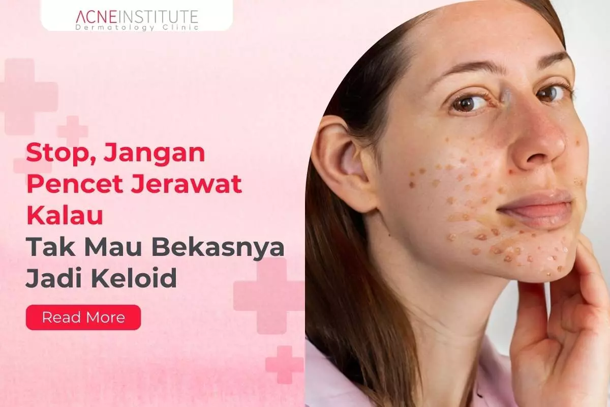 Stop, Jangan Pencet Jerawat Kalau Tak Mau Bekasnya Jadi Keloid