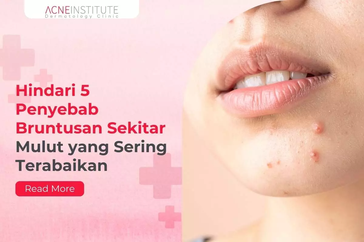 Hindari 5 Penyebab Bruntusan Sekitar Mulut yang Sering Terabaikan