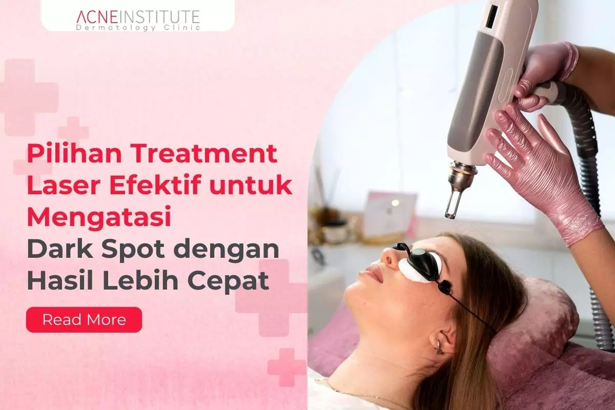 Pilihan Treatment Laser Efektif untuk Mengatasi Dark Spot dengan Hasil Lebih Cepat