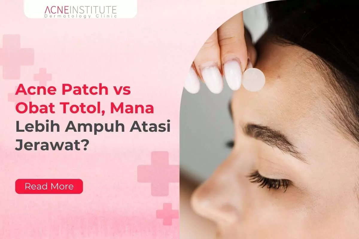 Acne Patch vs Obat Totol, Mana Lebih Ampuh Atasi Jerawat?