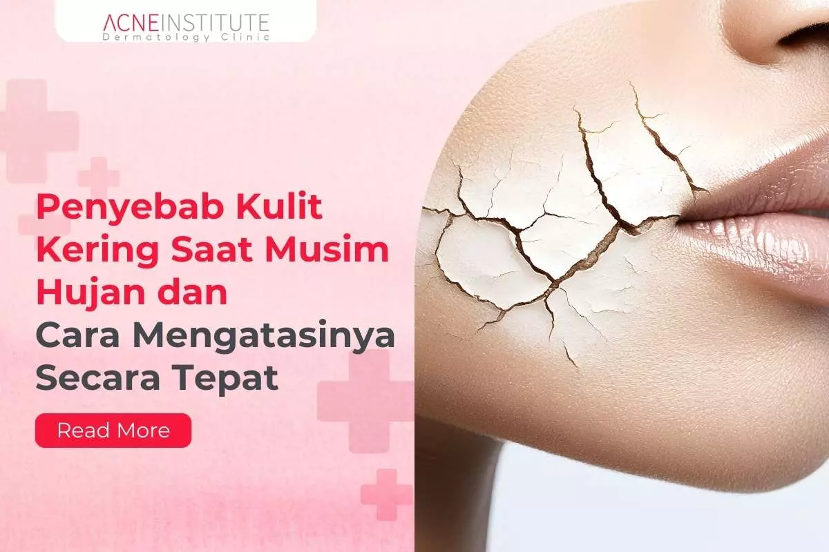 Penyebab Kulit Kering Saat Musim Hujan dan Cara Mengatasinya Secara Tepat