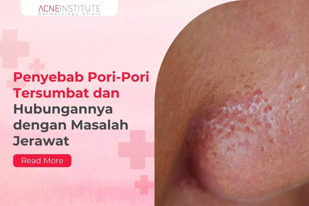 Penyebab Pori-Pori Tersumbat dan Hubungannya dengan Masalah Jerawat