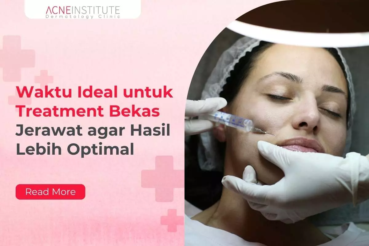 Waktu Ideal untuk Treatment Bekas Jerawat agar Hasil Lebih Optimal