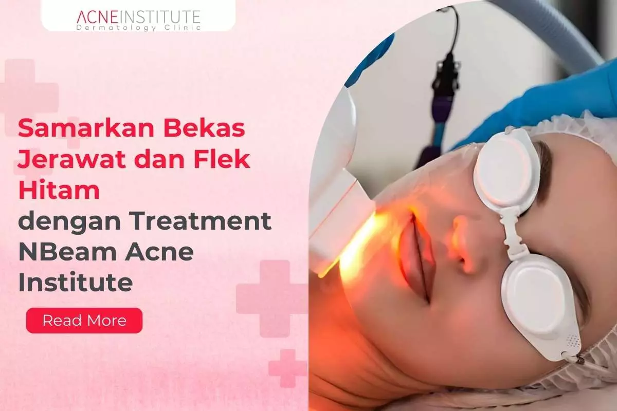 Samarkan Bekas Jerawat dan Flek Hitam dengan Treatment NBeam Acne Institute