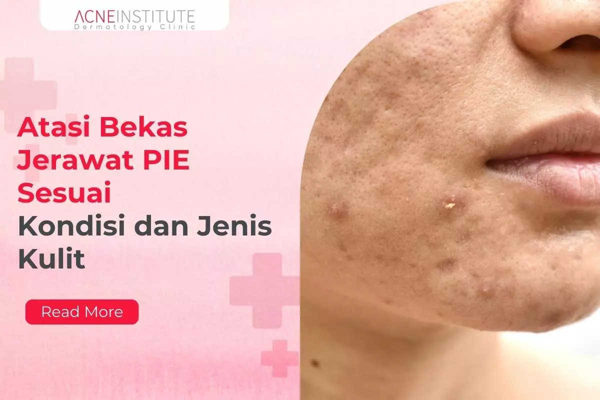 Atasi Bekas Jerawat PIE Sesuai Kondisi dan Jenis Kulit