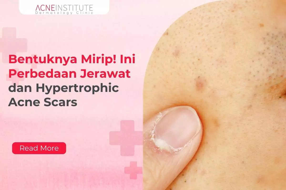 Bentuknya Mirip! Ini Perbedaan Jerawat dan Hypertrophic Acne Scars