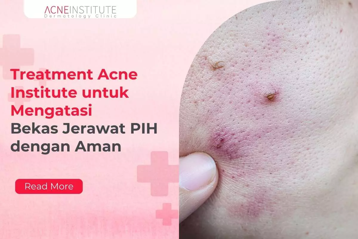 Treatment Acne Institute untuk Mengatasi Bekas Jerawat PIH dengan Aman