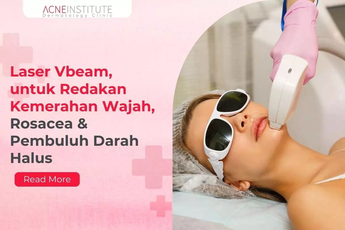 Laser Vbeam, Teknologi PDL untuk Redakan Kemerahan Wajah, Rosacea & Pembuluh Darah Halus