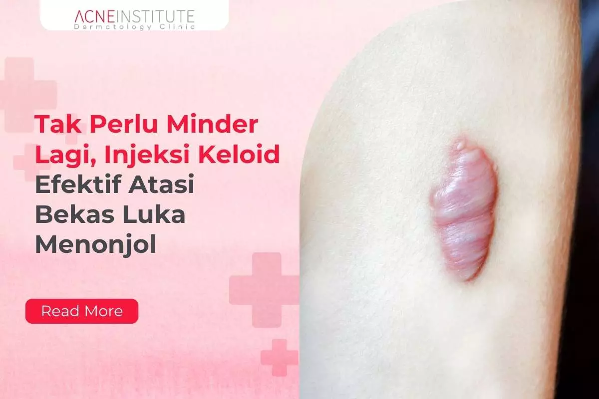 Tak Perlu Minder Lagi, Injeksi Keloid Efektif Atasi Bekas Luka Menonjol