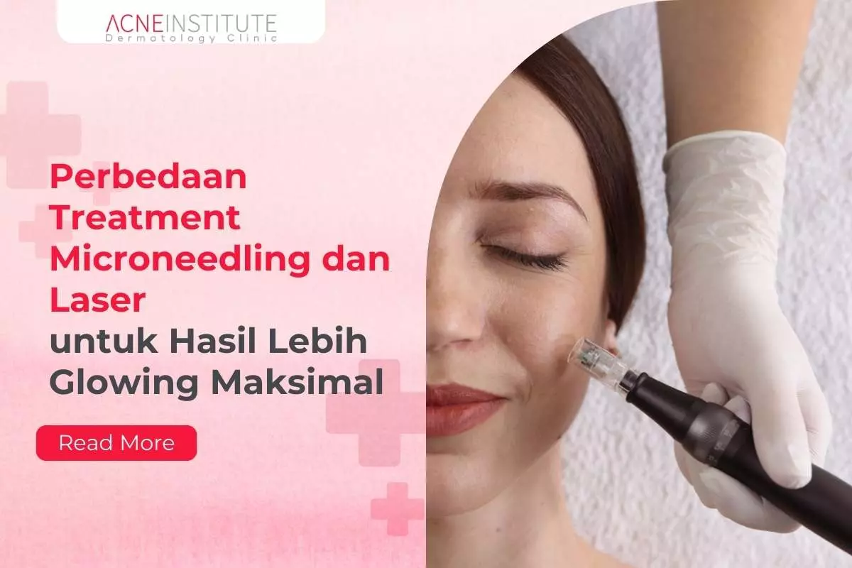 Perbedaan Treatment Microneedling dan Laser untuk Hasil Lebih Glowing Maksimal