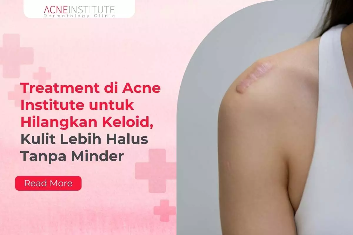 Treatment di Acne Institute untuk Hilangkan Keloid, Kulit Lebih Halus Tanpa Minder