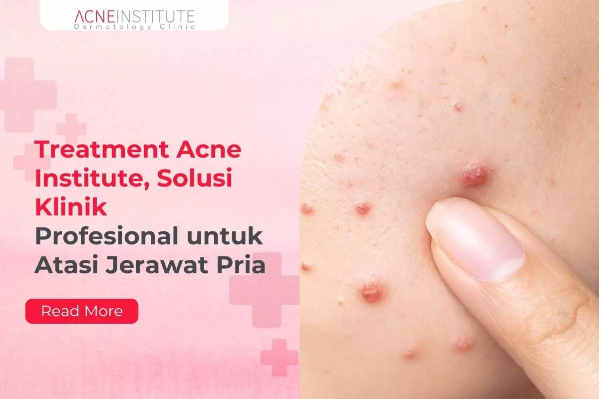 Treatment Acne Institute, Solusi Klinik Profesional untuk Atasi Jerawat Pria