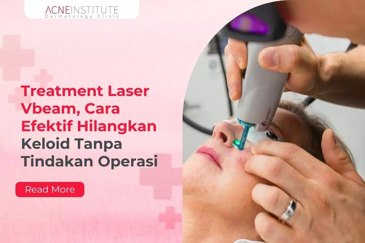 Treatment Laser Vbeam, Cara Efektif Hilangkan Keloid Tanpa Tindakan Operasi