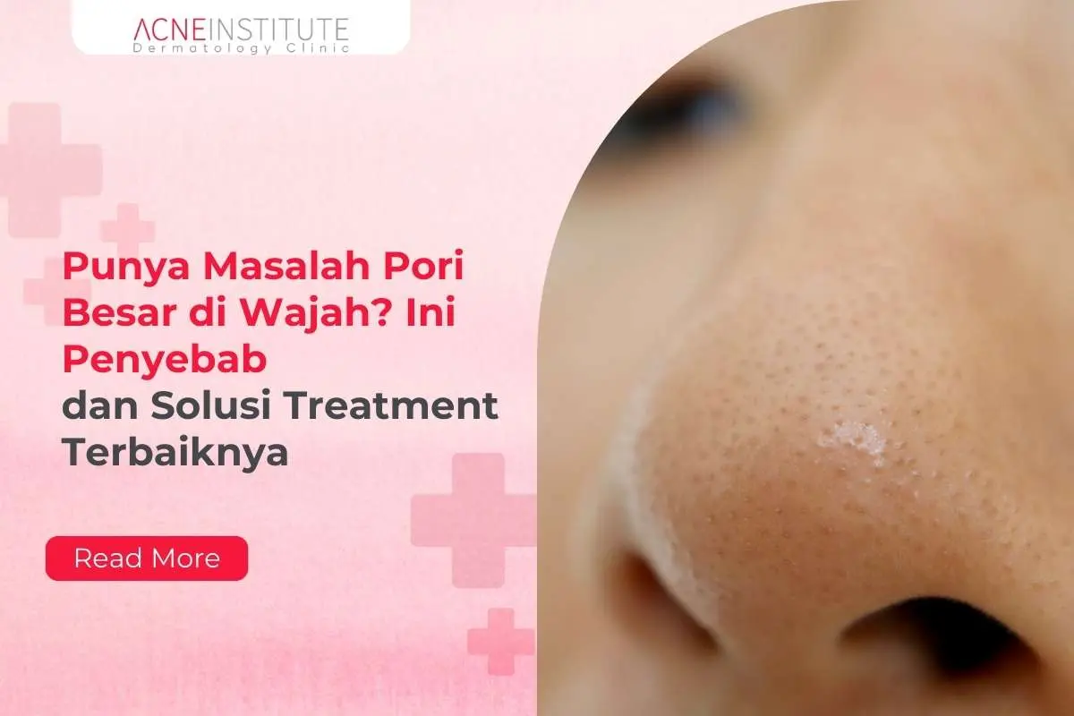 Punya Masalah Pori Besar di Wajah? Ini Penyebab dan Solusi Treatment Terbaiknya