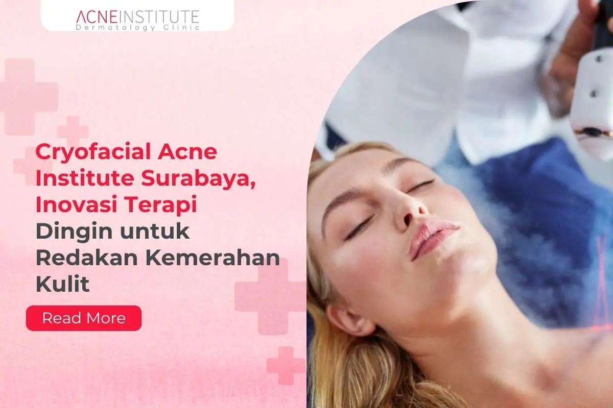 Cryofacial Acne Institute Surabaya, Inovasi Terapi Dingin untuk Redakan Kemerahan Kulit
