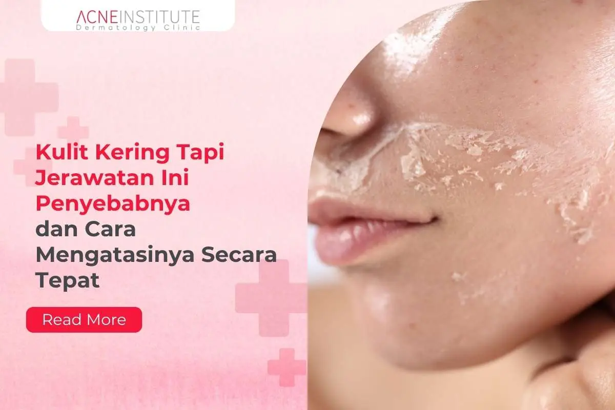 Kulit Kering Tapi Jerawatan Ini Penyebabnya dan Cara Mengatasinya Secara Tepat