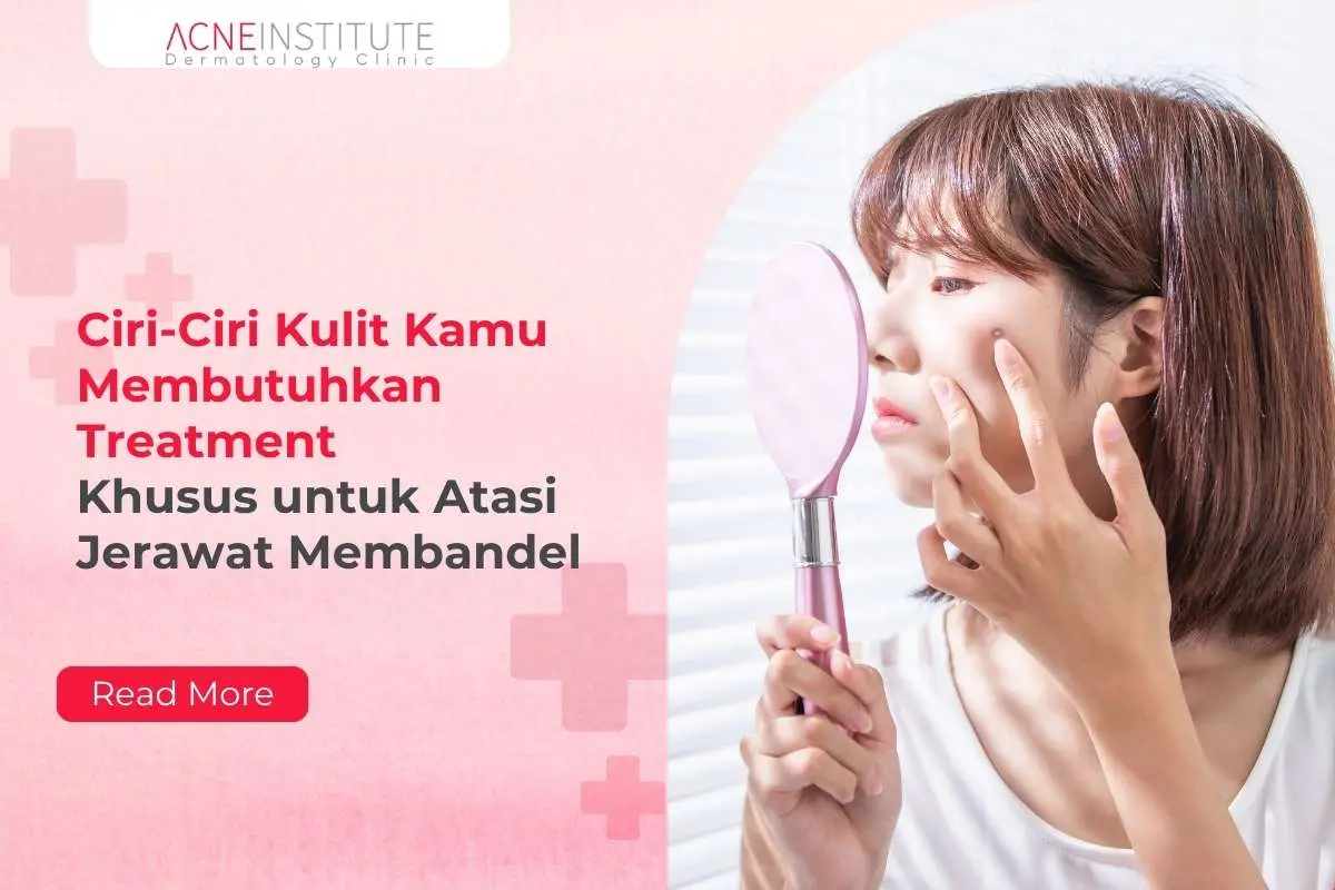 Ciri-Ciri Kulit Kamu Membutuhkan Treatment Khusus untuk Atasi Jerawat Membandel