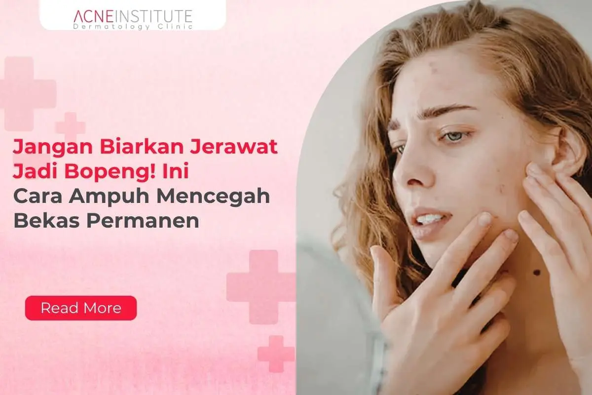 Jangan Biarkan Jerawat Jadi Bopeng! Ini Cara Ampuh Mencegah Bekas Permanen