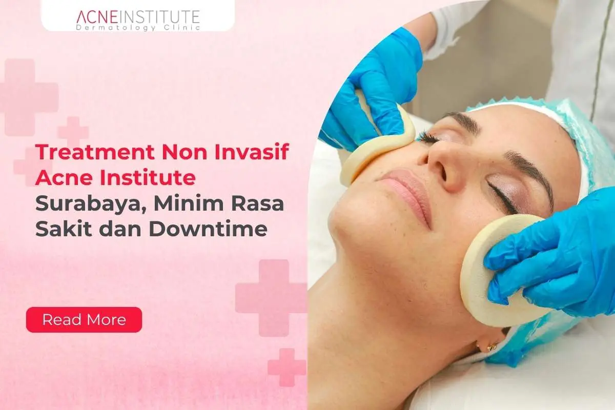 Treatment Non Invasif Acne Institute Surabaya, Minim Rasa Sakit dan Downtime