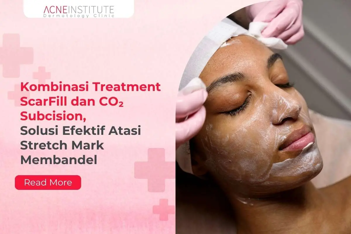 Kombinasi Treatment ScarFill dan CO2 Subcision, Solusi Efektif Atasi Stretch Mark Membandel