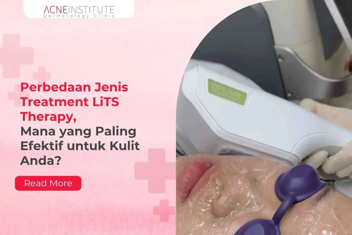 Perbedaan Jenis Treatment LiTS Therapy, Mana yang Paling Efektif untuk Kulit Anda?