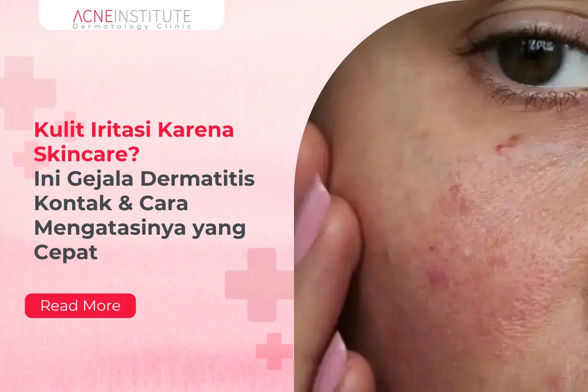 Kulit Iritasi Karena Skincare? Ini Gejala Dermatitis Kontak & Cara Mengatasinya yang Cepat
