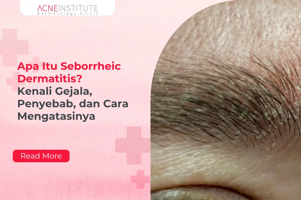 Apa Itu Seborrheic Dermatitis? Kenali Gejala, Penyebab, dan Cara Mengatasinya
