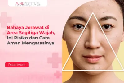 Bahaya Jerawat di Area Segitiga Wajah, Ini Risiko dan Cara Aman Mengatasinya
