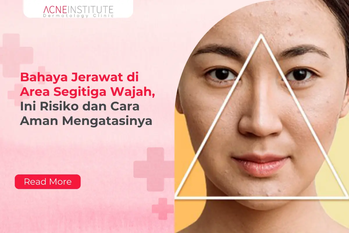 Bahaya Jerawat di Area Segitiga Wajah, Ini Risiko dan Cara Aman Mengatasinya