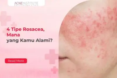 4 Tipe Rosacea, Mana yang Kamu Alami?
