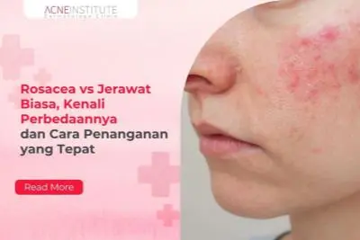 Rosacea vs Jerawat Biasa, Kenali Perbedaannya dan Cara Penanganan yang Tepat