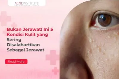 Bukan Jerawat! Ini 5 Kondisi Kulit yang Sering Disalahartikan Sebagai Jerawat