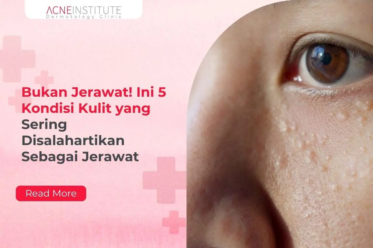 Bukan Jerawat! Ini 5 Kondisi Kulit yang Sering Disalahartikan Sebagai Jerawat