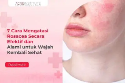 7 Cara Mengatasi Rosacea Secara Efektif dan Alami untuk Wajah Kembali Sehat