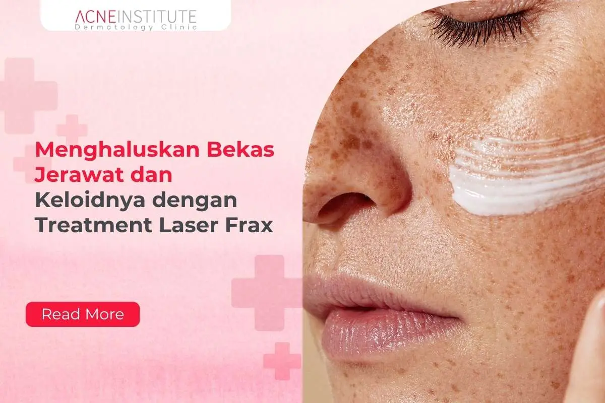 Menghaluskan Bekas Jerawat dan Keloidnya dengan Treatment Laser Frax
