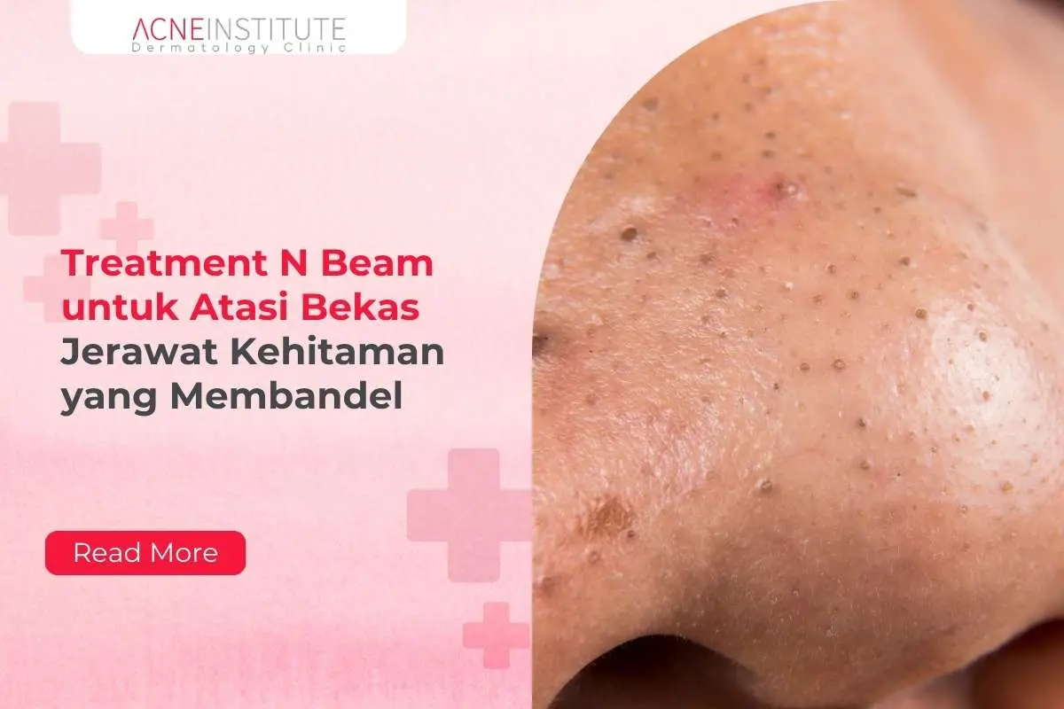 Treatment N Beam untuk Atasi Bekas Jerawat Kehitaman yang Membandel