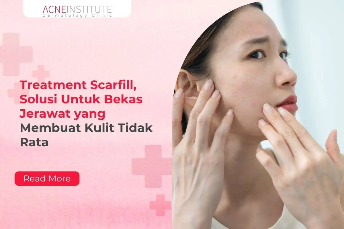 Treatment Scarfill, Solusi Untuk Bekas Jerawat yang Membuat Kulit Tidak Rata