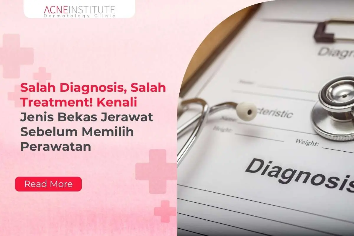 Salah Diagnosis, Salah Treatment! Kenali Jenis Bekas Jerawat Sebelum Memilih Perawatan