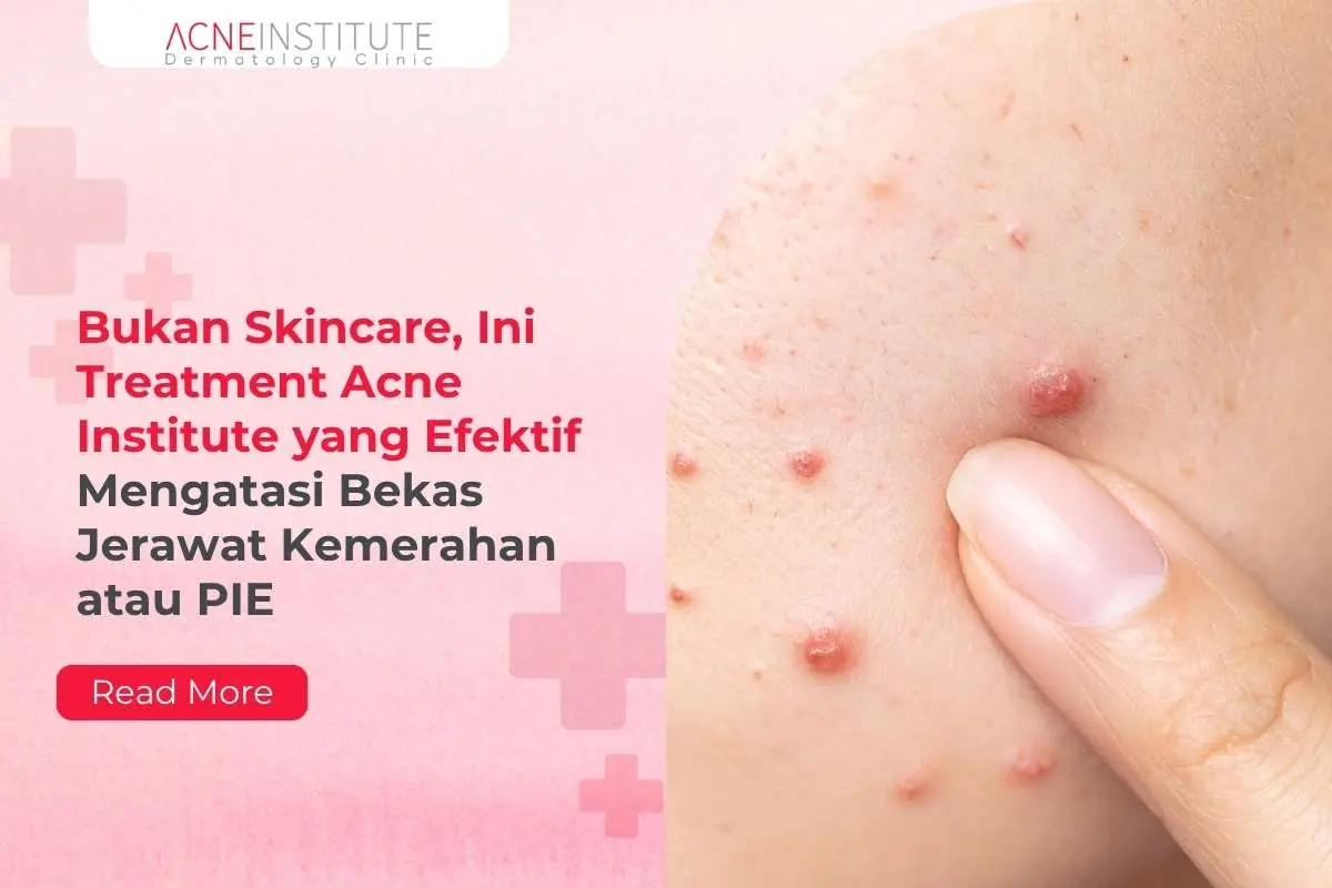 Bukan Skincare, Ini Treatment Acne Institute yang Efektif Mengatasi Bekas Jerawat Kemerahan atau PIE